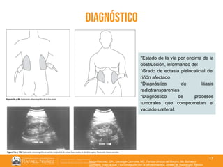 01/08/2018
17
diagnóstico
Motta-Ramírez, GA., Uscanga-Carmona, MC. Puntos clínicos de Murphy, Mc Burbey y
Giordano: Valor actual y su correlación con la ultrasonografía. Anales de Radiología. México
*Estado de la vía por encima de la
obstrucción, informando del
*Grado de ectasia pielocalicial del
riñón afectado
*Diagnóstico de litiasis
radiotransparentes
*Diagnóstico de procesos
tumorales que comprometan el
vaciado ureteral.
 