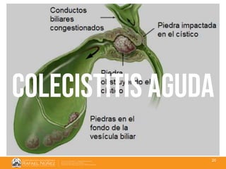 01/08/2018
20
colecistitis aguda
 