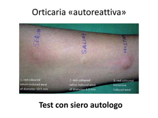 Orticaria «autoreattiva»




 Test con siero autologo
 