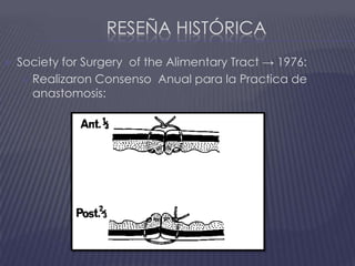 Reseña históricaSocietyforSurgery  of theAlimentaryTract -> 1976:Realizaron Consenso  Anual para la Practica de anastomosis:
