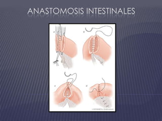 Anastomosis intestinales