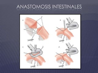 Anastomosis intestinales