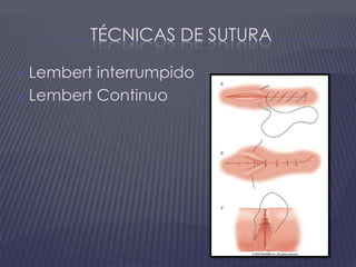Técnicas de suturaLembert interrumpidoLembert Continuo