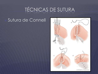 Técnicas de suturaSutura de Connell