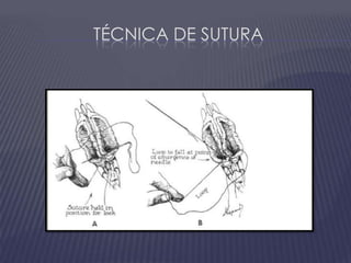 Técnica de sutura