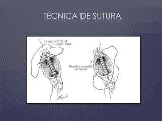Técnica de sutura