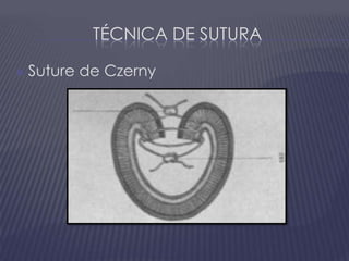 Técnica de suturaSuture de Czerny