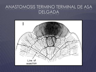 Anastomosis termino terminal de asa delgada