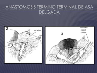 Anastomosis termino terminal de asa delgada
