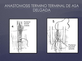 Anastomosis termino terminal de asa delgada
