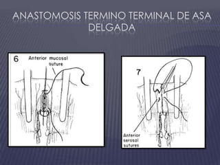 Anastomosis termino terminal de asa delgada