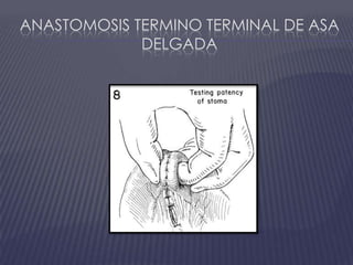 Anastomosis termino terminal de asa delgada