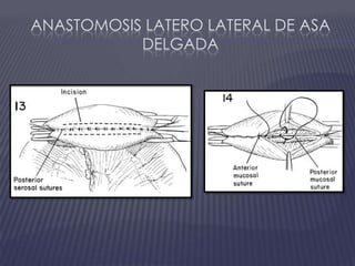 Anastomosis Latero lateral de asa delgada
