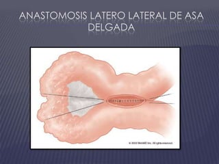 Anastomosis Latero lateral de asa delgada