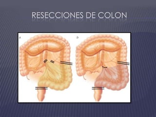 Resecciones de colon