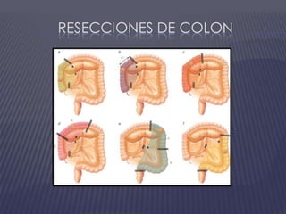 Resecciones de colon