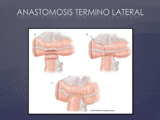 Anastomosis termino lateral