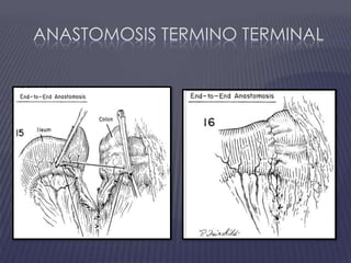 Anastomosis termino terminal 