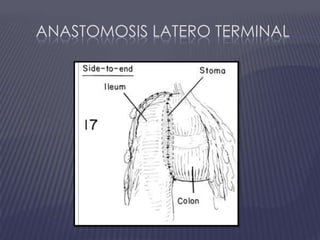 Anastomosis latero terminal
