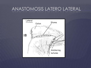 Anastomosis latero lateral