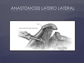 Anastomosis Latero Lateral