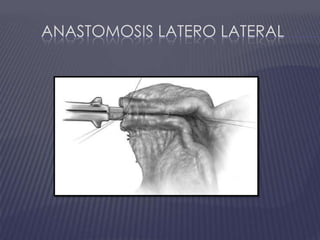 Anastomosis Latero Lateral