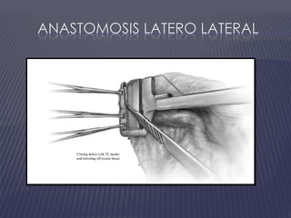 Anastomosis Latero Lateral