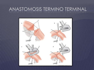 Anastomosis terminO terminal
