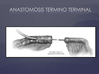Anastomosis termino terminal