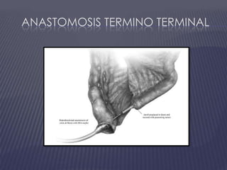 Anastomosis termino terminal