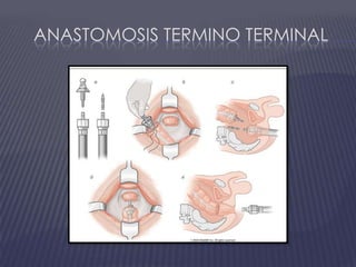 Anastomosis termino terminal
