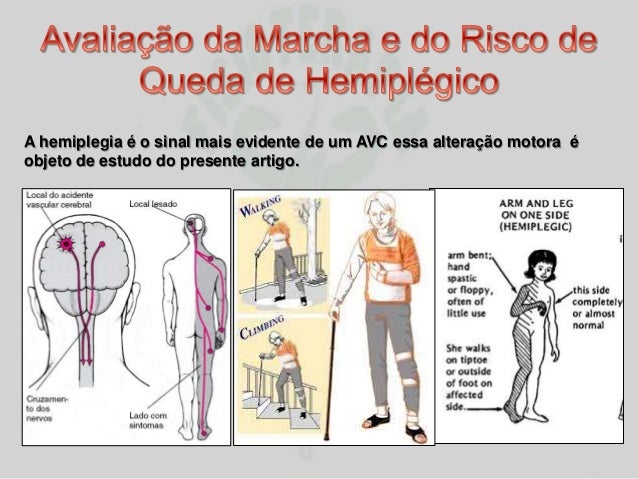 AVC HEMIPLEGIA PDF