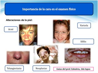 Guías del prof. Zabaleta, 2do lapso
Alteraciones de la piel:
Acné
Telangiectasia Neoplasias
Varicela
Sífilis
 