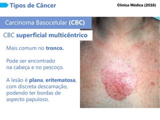 Tipos de Câncer
Carcinoma Basocelular (CBC)
Clínica Médica (2016)
CBC superficial multicêntrico
Mais comum no tronco.
Pode ser encontrado
na cabeça e no pescoço.
A lesão é plana, eritematosa,
com discreta descamação,
podendo ter bordas de
aspecto papuloso.
 