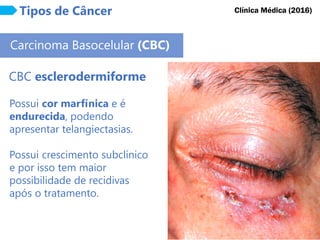 Tipos de Câncer
Carcinoma Basocelular (CBC)
CBC esclerodermiforme
Possui cor marfínica e é
endurecida, podendo
apresentar telangiectasias.
Possui crescimento subclínico
e por isso tem maior
possibilidade de recidivas
após o tratamento.
Clínica Médica (2016)
 