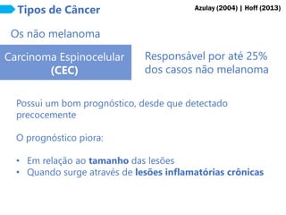 Tipos de Câncer
Carcinoma Espinocelular
(CEC)
Os não melanoma
Responsável por até 25%
dos casos não melanoma
Azulay (2004) | Hoff (2013)
Possui um bom prognóstico, desde que detectado
precocemente
O prognóstico piora:
• Em relação ao tamanho das lesões
• Quando surge através de lesões inflamatórias crônicas
 
