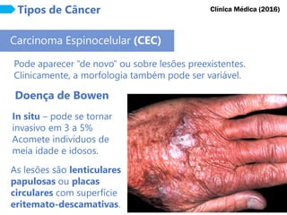 Tipos de Câncer
Carcinoma Espinocelular (CEC)
Doença de Bowen
Pode aparecer “de novo” ou sobre lesões preexistentes.
Clinicamente, a morfologia também pode ser variável.
Clínica Médica (2016)
In situ – pode se tornar
invasivo em 3 a 5%
Acomete indivíduos de
meia idade e idosos.
As lesões são lenticulares
papulosas ou placas
circulares com superfície
eritemato-descamativas.
 