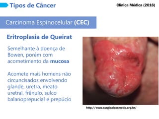 Tipos de Câncer
Carcinoma Espinocelular (CEC)
Eritroplasia de Queirat
Clínica Médica (2016)
Semelhante à doença de
Bowen, porém com
acometimento da mucosa
Acomete mais homens não
circuncisados envolvendo
glande, uretra, meato
uretral, frênulo, sulco
balanoprepucial e prepúcio
http://www.surgicalcosmetic.org.br/
 