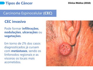 Tipos de Câncer
Carcinoma Espinocelular (CEC)
CEC invasivo
Clínica Médica (2016)
Pode formar infiltrações,
nodulações, ulcerações ou
vegetações.
Em torno de 2% dos casos
diagnosticados já cursam
com metástases, sendo os
linfonodos regionais e as
vísceras os locais mais
acometidos.
 