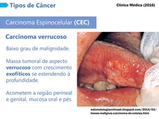 Tipos de Câncer
Carcinoma Espinocelular (CEC)
Carcinoma verrucoso
Clínica Médica (2016)
Baixo grau de malignidade.
Massa tumoral de aspecto
verrucoso com crescimento
exofíticos se estendendo à
profundidade.
Acometem a região perineal
e genital, mucosa oral e pés.
estomatologiaonlinepb.blogspot.com/2014/03/
lesoes-malignas-carcinoma-de-celulas.html
 