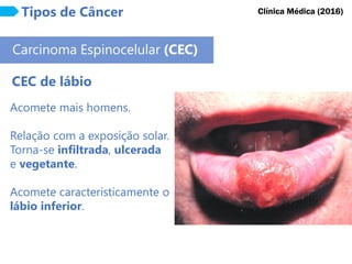 Tipos de Câncer
Carcinoma Espinocelular (CEC)
CEC de lábio
Clínica Médica (2016)
Acomete mais homens.
Relação com a exposição solar.
Torna-se infiltrada, ulcerada
e vegetante.
Acomete caracteristicamente o
lábio inferior.
 