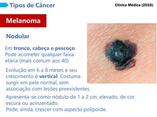 Em tronco, cabeça e pescoço.
Pode acometer qualquer faixa
etária (mais comum aos 40)
Melanoma
Tipos de Câncer
Nodular
Clínica Médica (2016)
Evolução em 6 a 8 meses e seu
crescimento é vertical. Costuma
surgir em pele normal, sem
associação com lesões preexistentes.
Apresenta-se como nódulo de 1 a 2 cm, elevado, de cor
escura ou acinzentado.
Pode, ainda, crescer com aspecto polipoide.
 