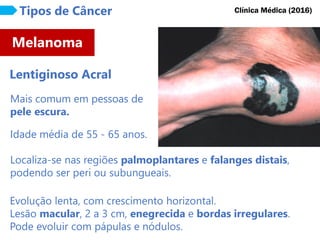 Mais comum em pessoas de
pele escura.
Melanoma
Tipos de Câncer
Lentiginoso Acral
Clínica Médica (2016)
Idade média de 55 - 65 anos.
Localiza-se nas regiões palmoplantares e falanges distais,
podendo ser peri ou subungueais.
Evolução lenta, com crescimento horizontal.
Lesão macular, 2 a 3 cm, enegrecida e bordas irregulares.
Pode evoluir com pápulas e nódulos.
 