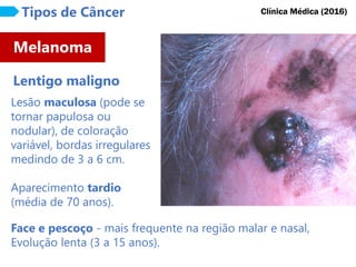 Lesão maculosa (pode se
tornar papulosa ou
nodular), de coloração
variável, bordas irregulares
medindo de 3 a 6 cm.
Aparecimento tardio
(média de 70 anos).
Melanoma
Tipos de Câncer
Lentigo maligno
Clínica Médica (2016)
Face e pescoço - mais frequente na região malar e nasal,
Evolução lenta (3 a 15 anos).
 