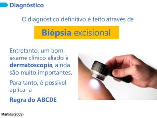 Martins (2009)
Diagnóstico
Biópsia excisional
O diagnóstico definitivo é feito através de
Entretanto, um bom
exame clínico aliado à
dermatoscopia, ainda
são muito importantes.
Para tanto, é possível
aplicar a
Regra do ABCDE
 
