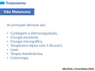 SBD (2019) | Clínica Médica (2016)
Tratamento
As principais técnicas são:
• Curetagem e eletrocoagulação,
• Cirurgia excisional,
• Cirurgia micrográfica,
• Terapêutica tópica com 5-fluoracil,
• Laser,
• Terapia fotodinâmica,
• Criocirurgia,
Não Melanoma
 