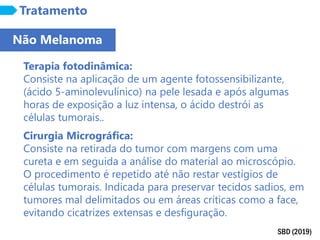 SBD (2019)
Tratamento
Terapia fotodinâmica:
Consiste na aplicação de um agente fotossensibilizante,
(ácido 5-aminolevulínico) na pele lesada e após algumas
horas de exposição a luz intensa, o ácido destrói as
células tumorais..
Não Melanoma
Cirurgia Micrográfica:
Consiste na retirada do tumor com margens com uma
cureta e em seguida a análise do material ao microscópio.
O procedimento é repetido até não restar vestígios de
células tumorais. Indicada para preservar tecidos sadios, em
tumores mal delimitados ou em áreas críticas como a face,
evitando cicatrizes extensas e desfiguração.
 