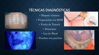 Cáncer de piel | PPTX