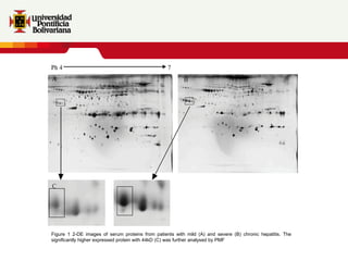 Figure 1 2-DE images of serum proteins from patients with mild (A) and severe (B) chronic hepatitis. The significantly higher expressed protein with 44kD (C) was further analysed by PMF 