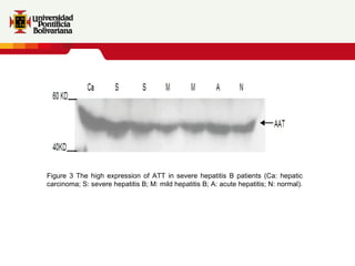Figure 3 The high expression of ATT in severe hepatitis B patients (Ca: hepatic carcinoma; S: severe hepatitis B; M: mild  hepatitis B; A: acute hepatitis; N: normal). 